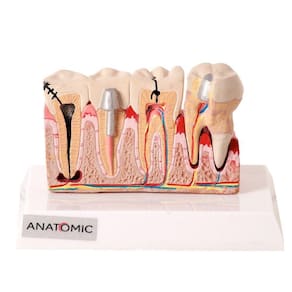 Patologia Dentária e Placa Explicativa em 2 Partes Modelo Anatômico