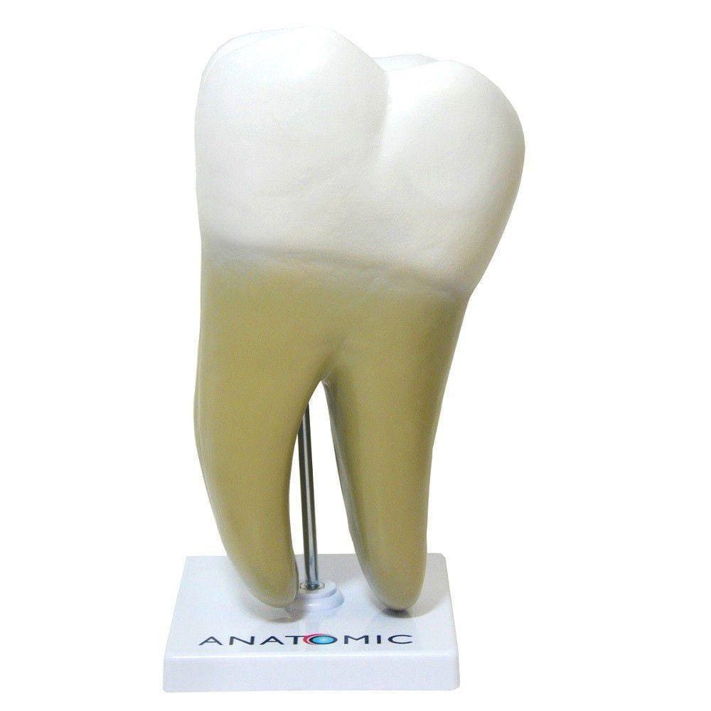 Dente Molar Ampliado Saudável E Cárie Modelo Anatomia
