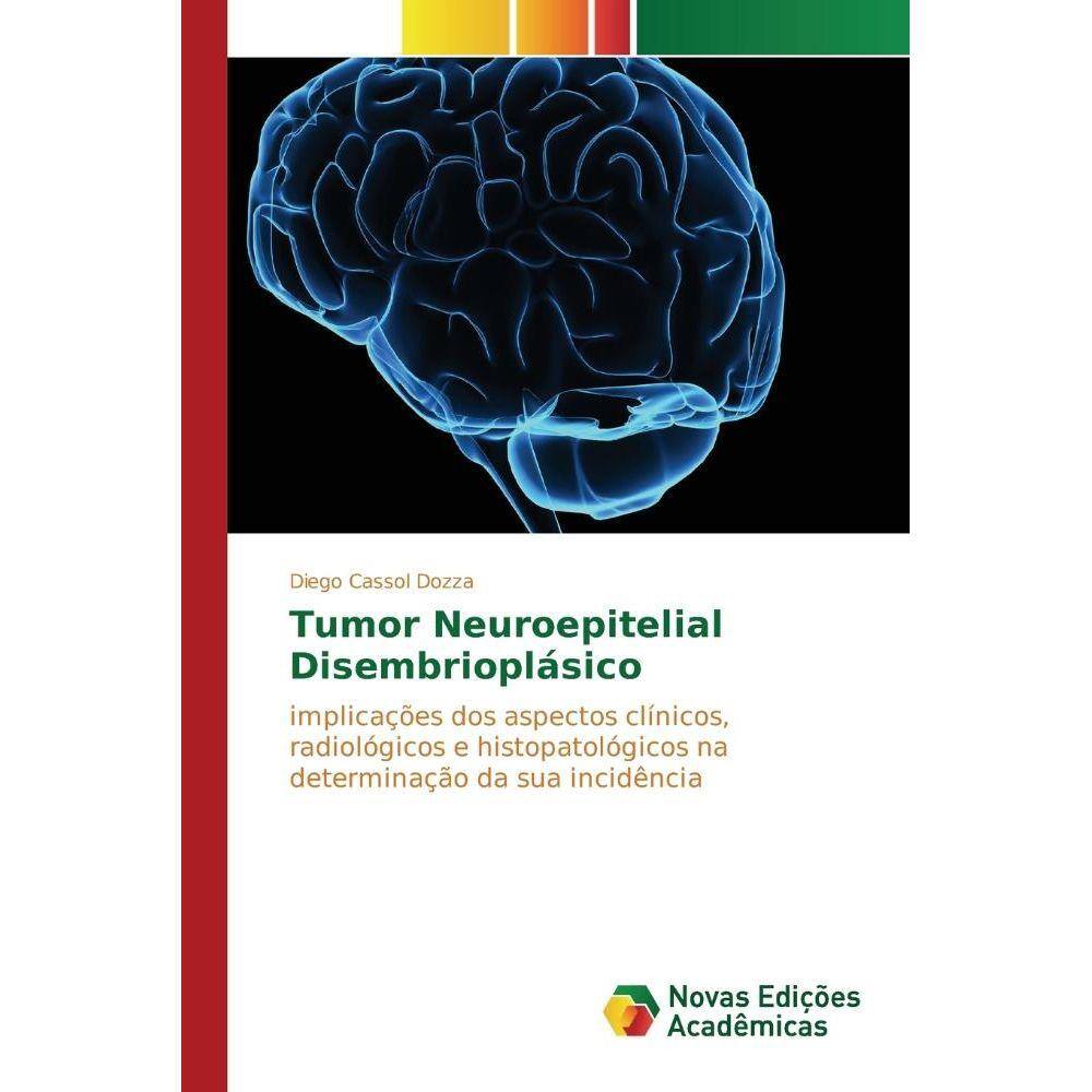Tumor neuroepitelial disembrioplsico Pontofrio