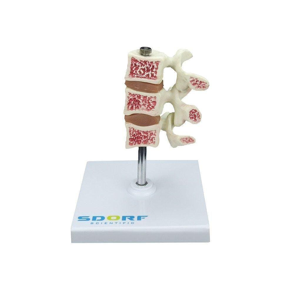 Modelo De Osteoporose Patológico