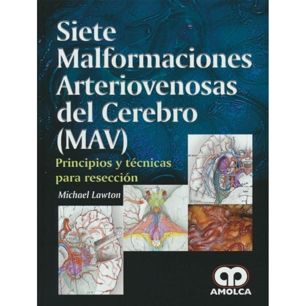 Siete Malformaciones Arteriovenosas Del Cerebro (mav)