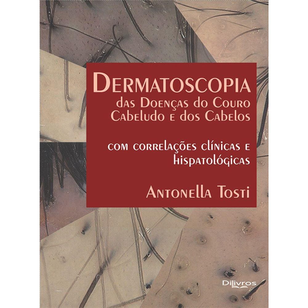 Dermatoscopia Das Doencas Do Couro Cabeludo E Dos Cabelos