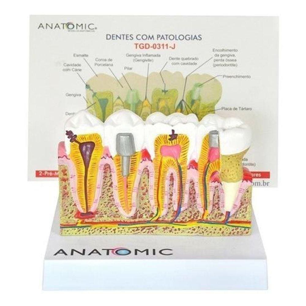 Patologia Dentária E Placa Explicativa Em 2 Partes, Anatomia