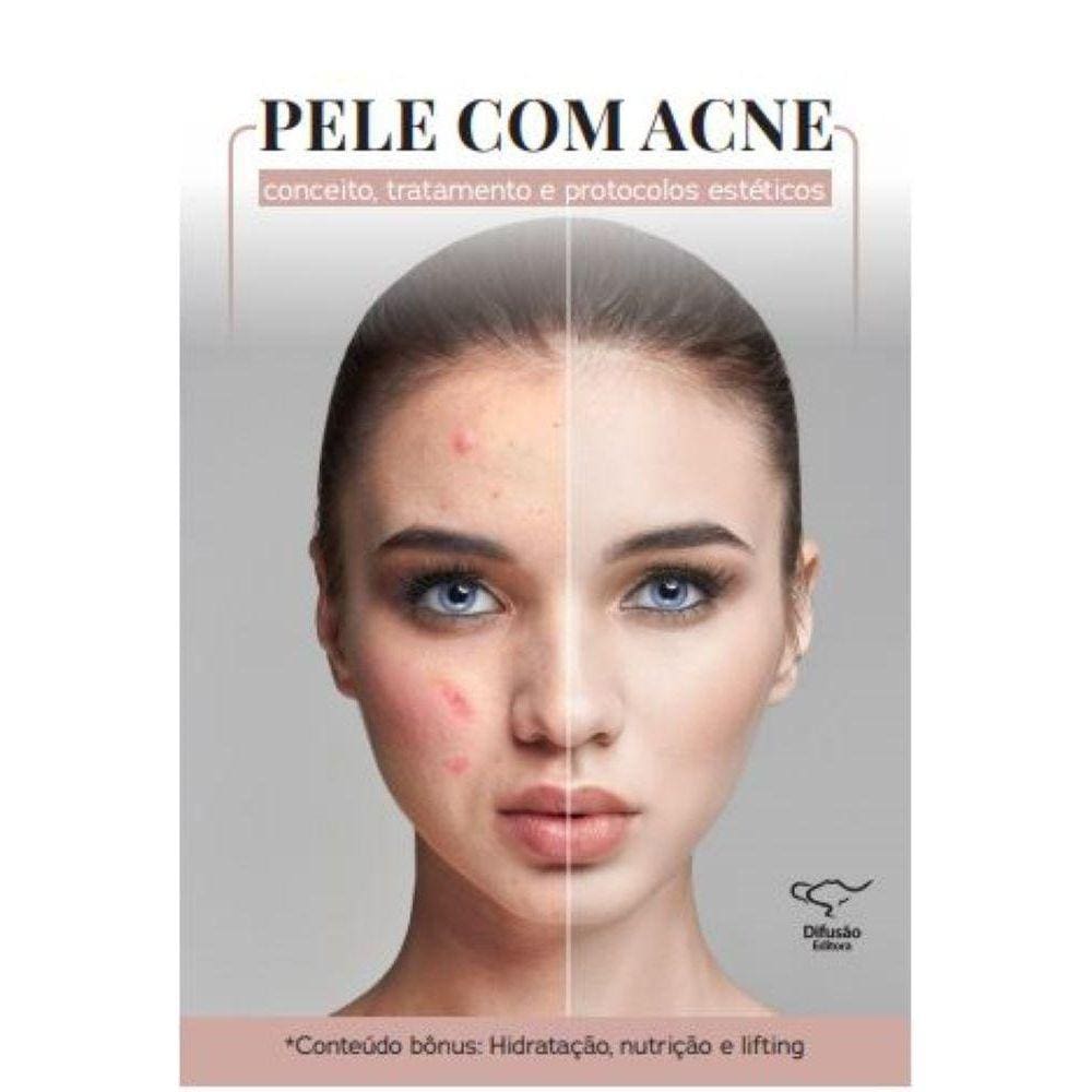 Litio acne pontofrio
