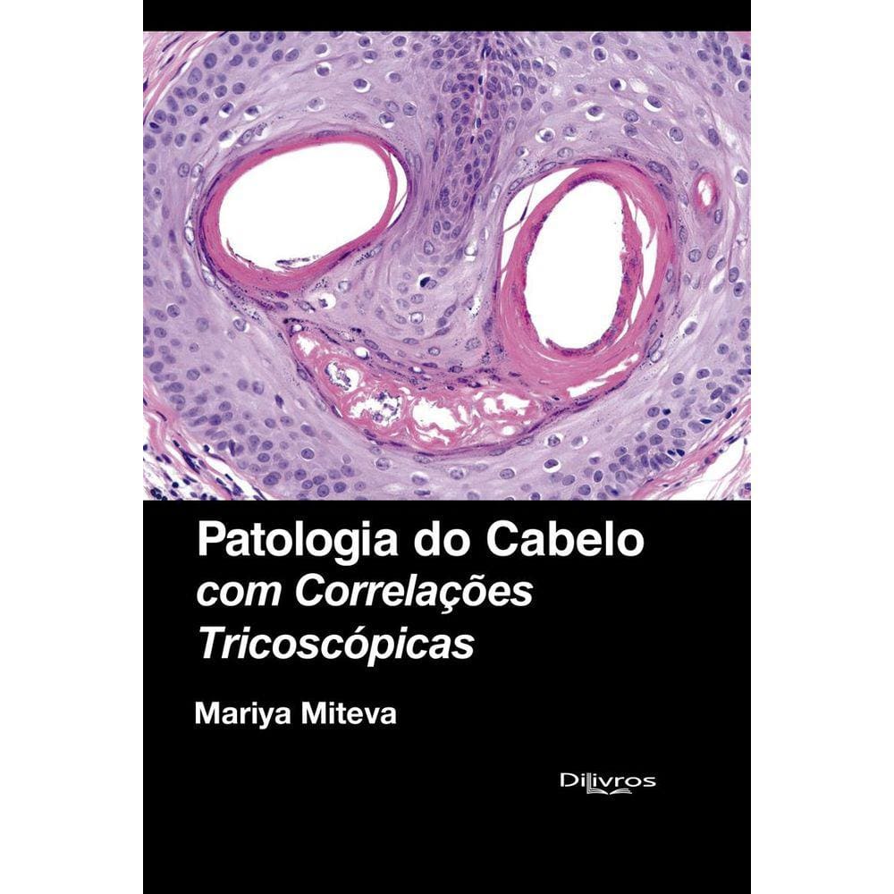 Patologia do Cabelo com Correlações Tricoscopias