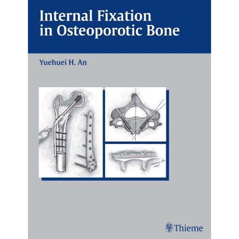 Internal Fixation In Osteoporotic Bone