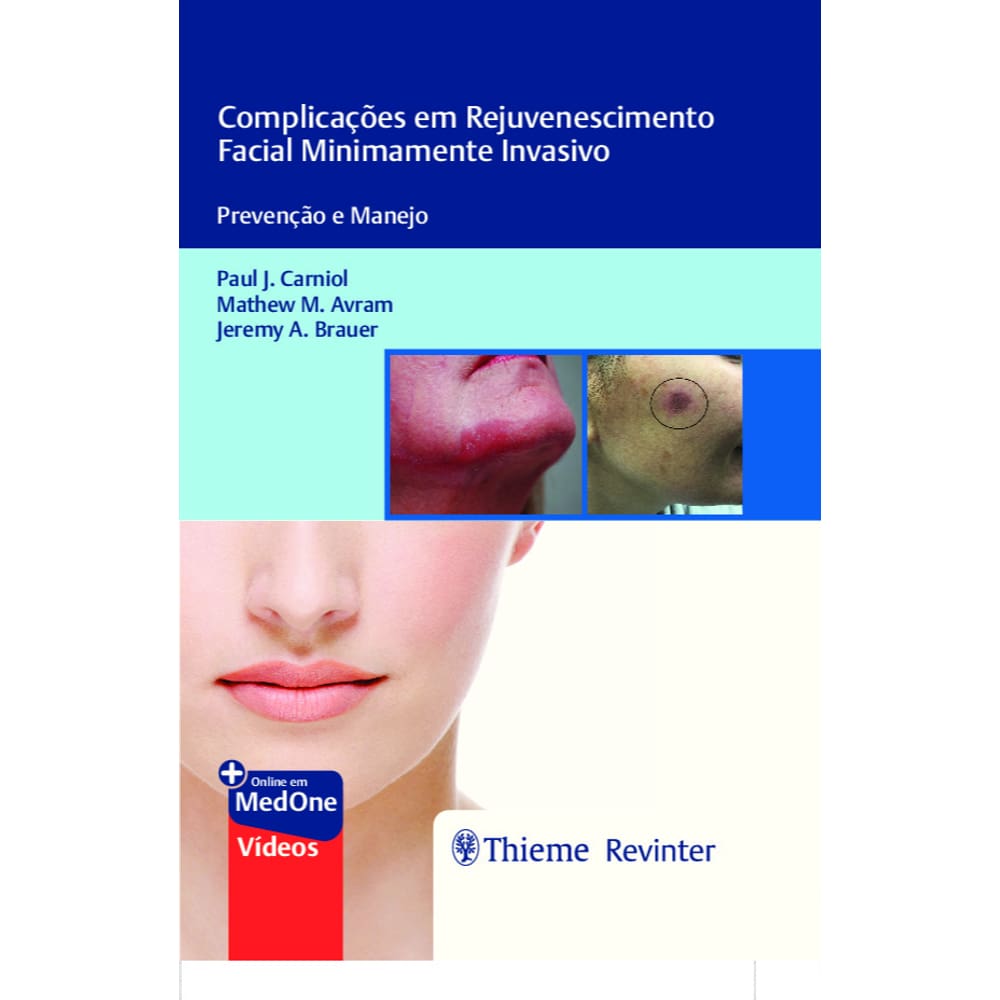 Complicaes Em Rejuvenescimento Facial Minimamente Invasivo
