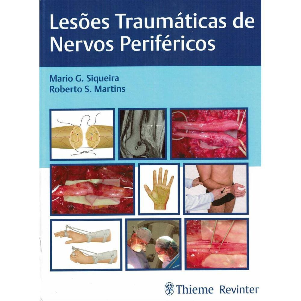 Lesoes Traumaticas De Nervos Perifericos