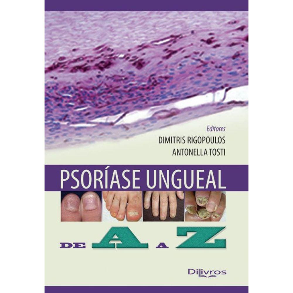 Psoriase Ungueal De A A Z