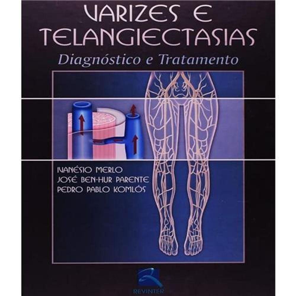Varizes E Telangiectisias