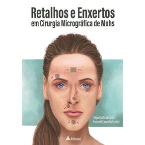 Retalhos E Enxertos Em Cirurgia Micrografica De Mohs