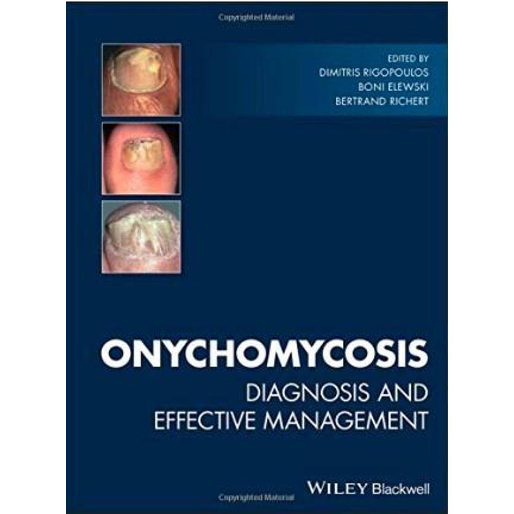 Onychomycosis: Diagnosis And Effective Management