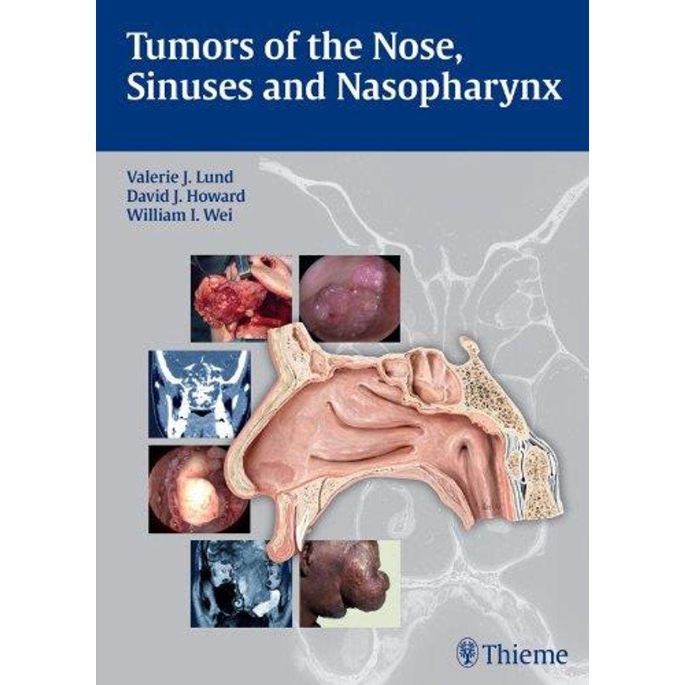 Tumors Of The Nose, Sinuses And Nasopharynux