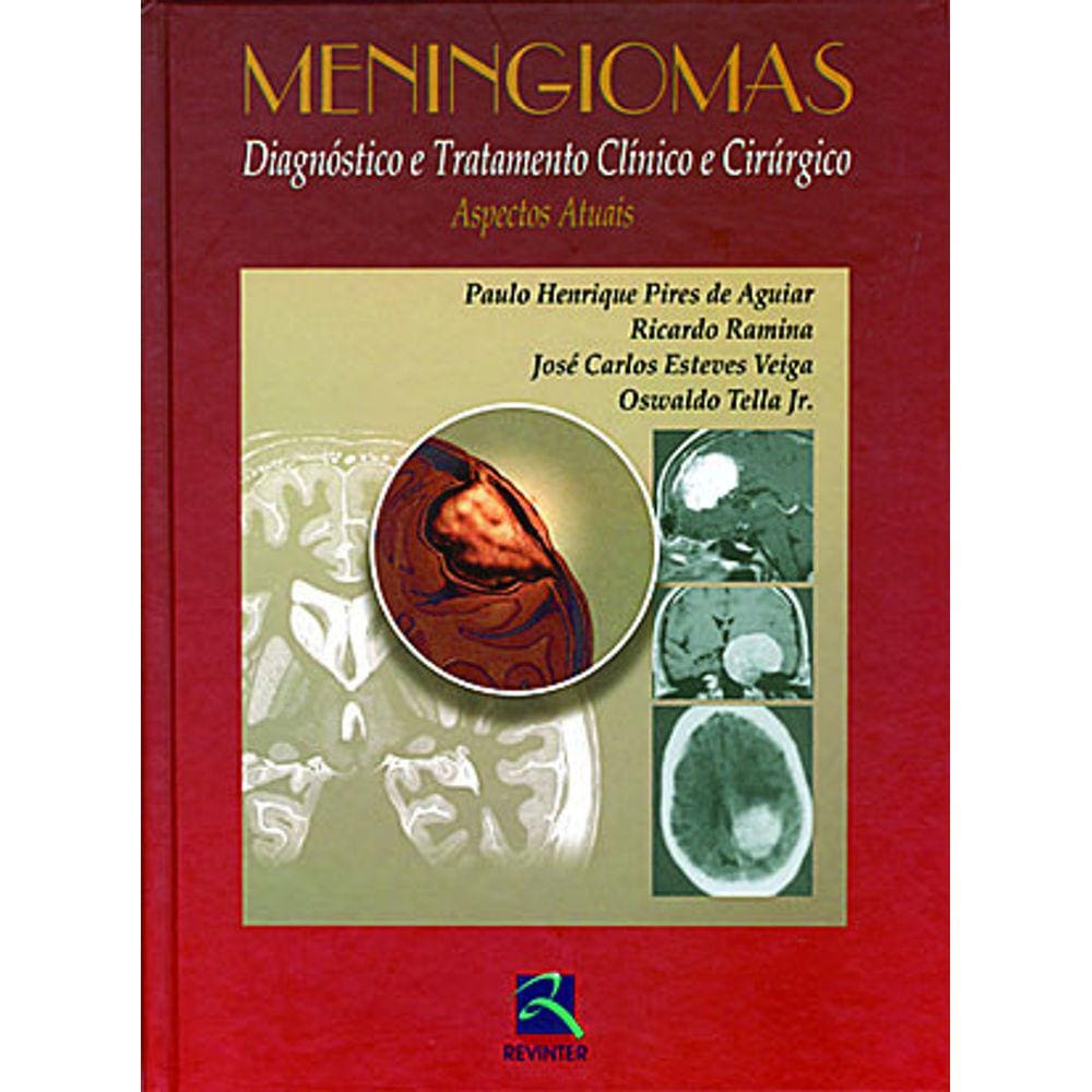 Meningiomas Diagnostico E Tratamento Clinico E Cirurgico