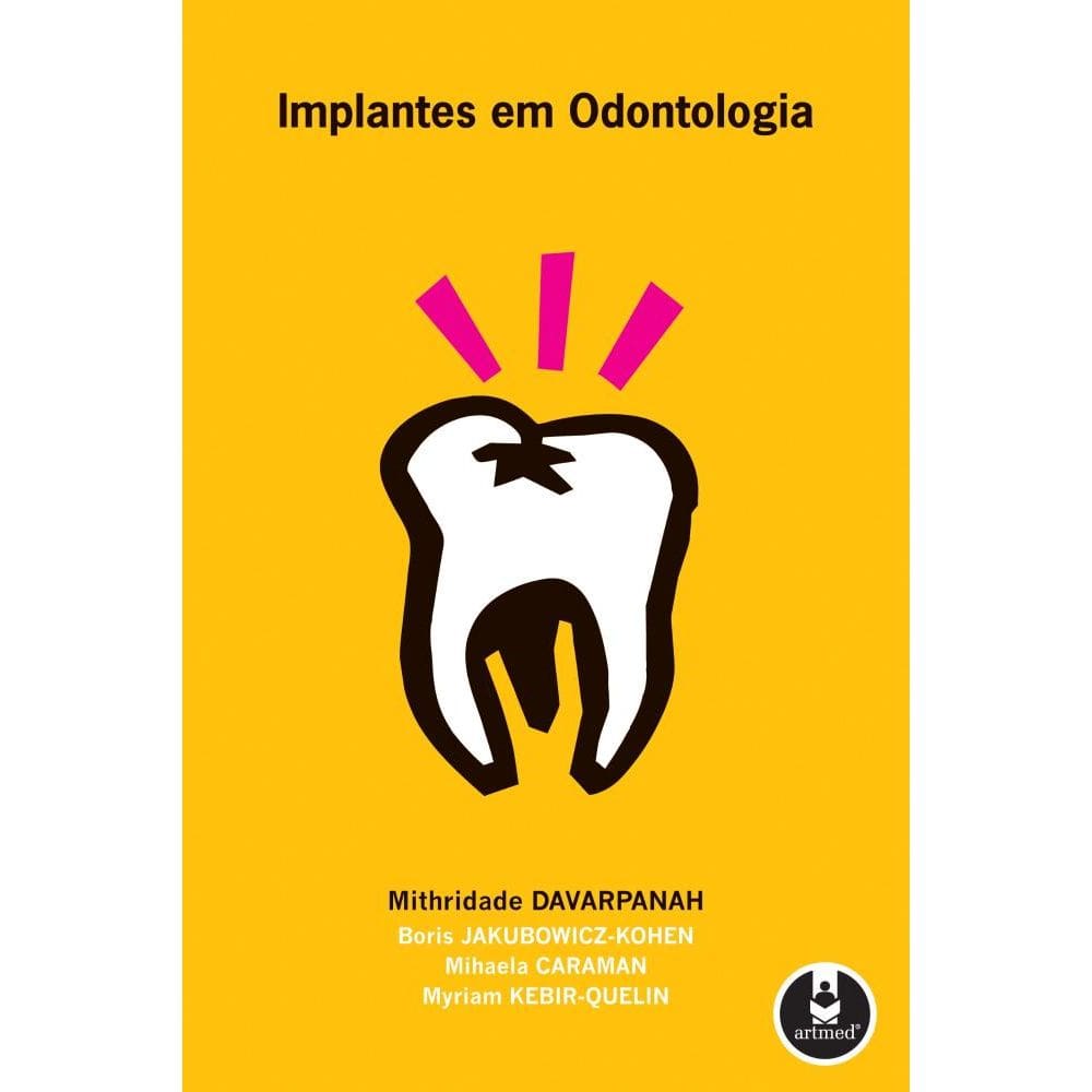 Implantes em Odontologia