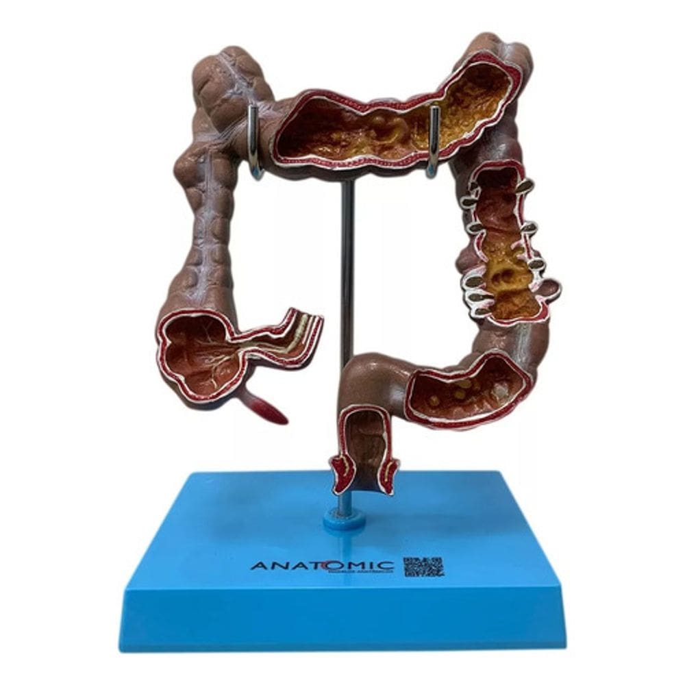 Intestino Humano Grosso Colon Ascendente Descendente E Reto
