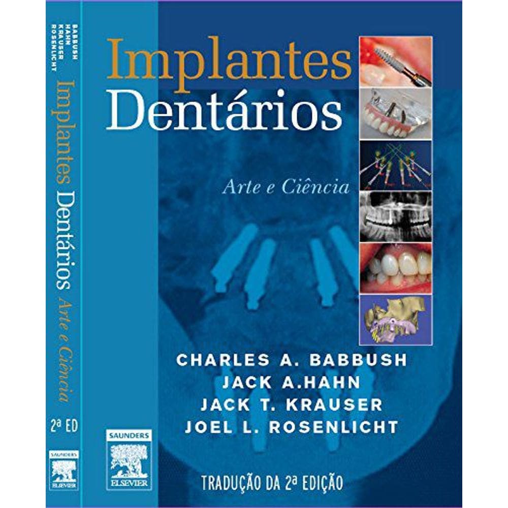 Implantes Dentários. Arte e Ciência