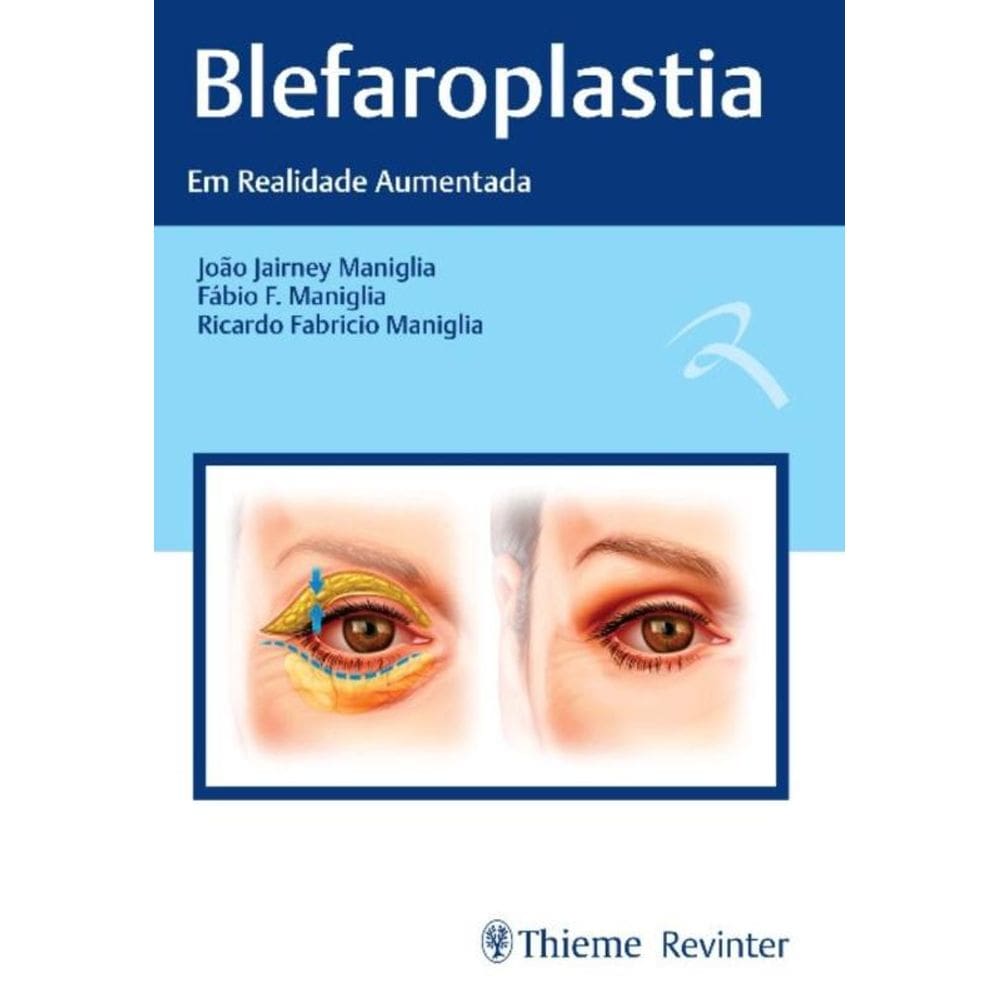 Blefaroplastia