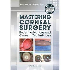 Mastering Corneal Surgery