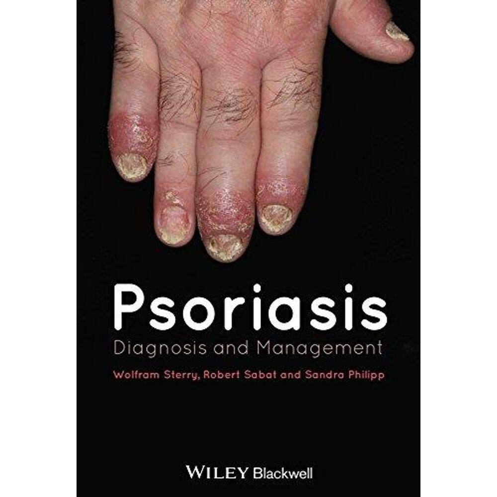 Psoriasis: Diagnosis And Management