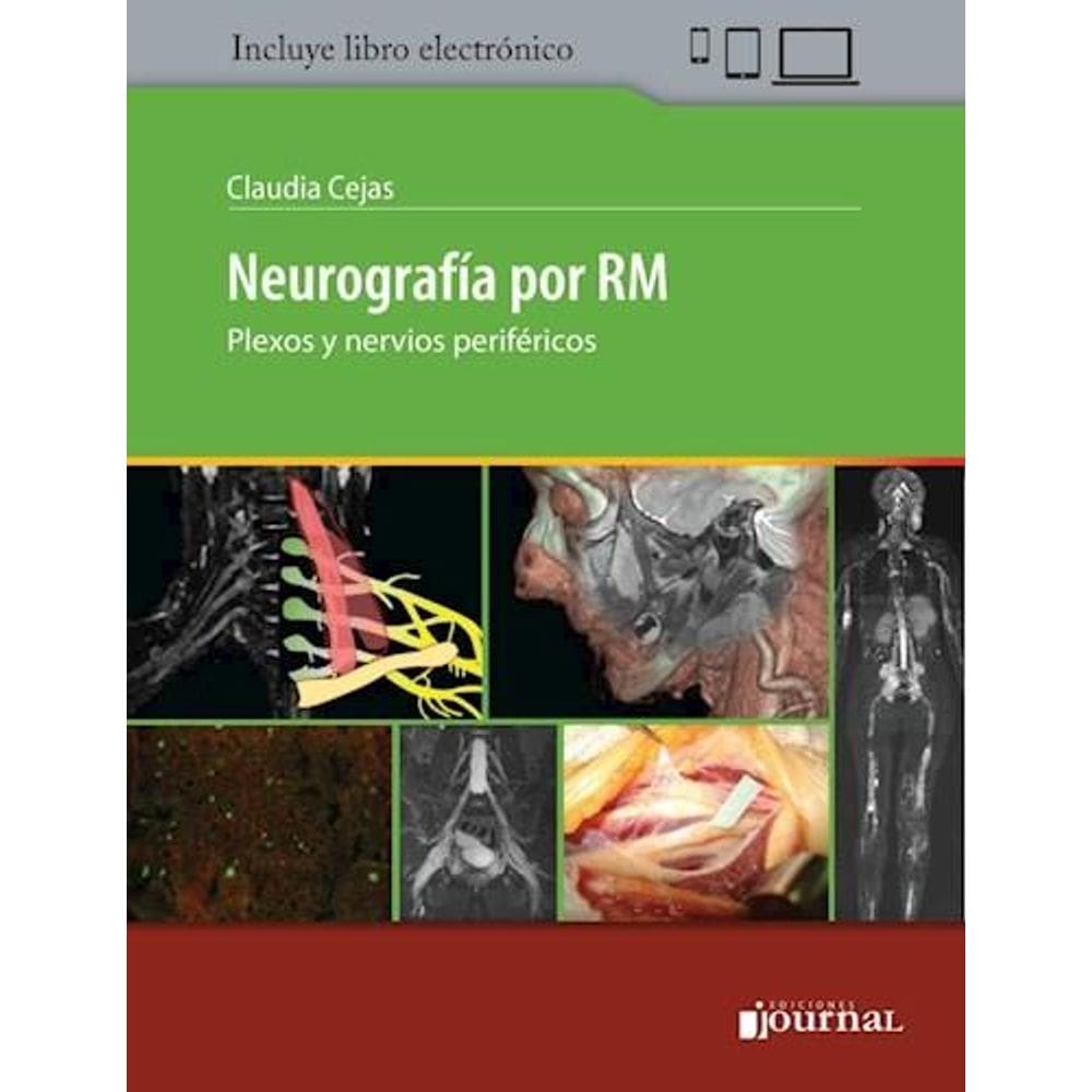 Neurografia Por Rm   (Espanhol)