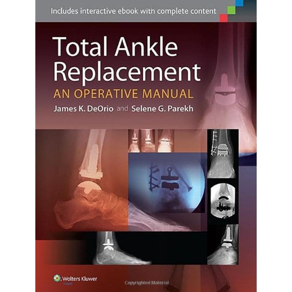 Total Ankle Replacement: An Operative Manual