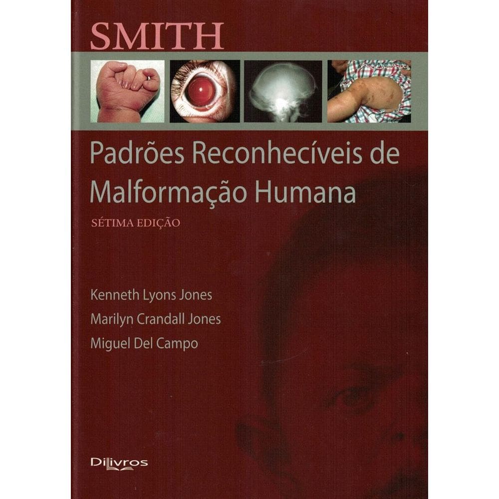 Smith Padroes Reconheciveis De Malformacao Humana