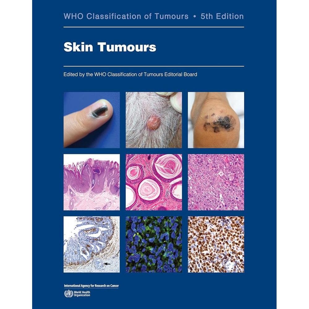 Skin Tumours