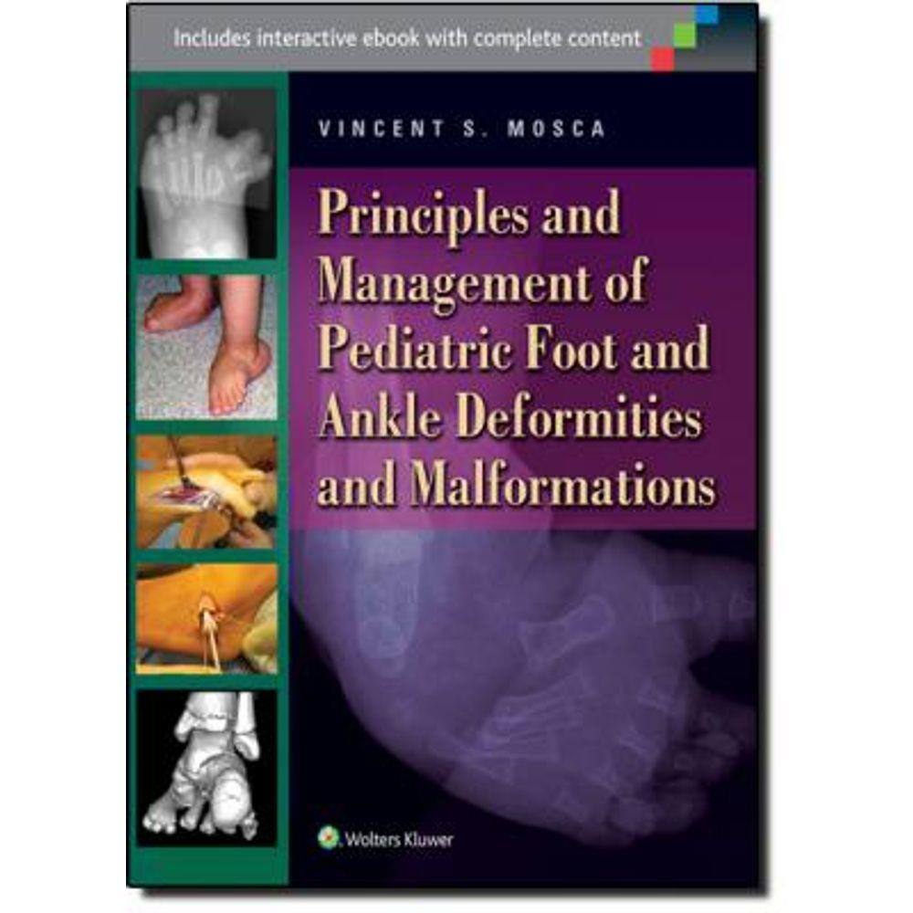 Principles And Management Of Pediatric Foot And Ankle Deformities And Malformations